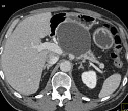 Serous Cystadenoma - CTisus CT Scan