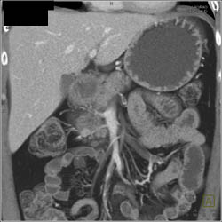 Insulinoma - CTisus CT Scan
