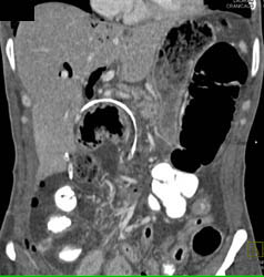 Perforated Duodenum S/P ERCP - CTisus CT Scan