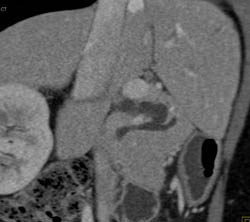 Intraductal Papillary Mucinous Neoplasm (IPMN) Off Pancreatic Duct - CTisus CT Scan