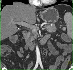 Tumor in Tail of Pancreas - CTisus CT Scan