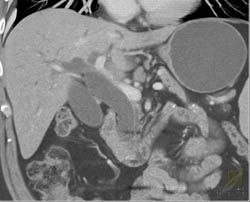 Dilated Common Bile Duct (CBD) With Ampullary Mass - CTisus CT Scan