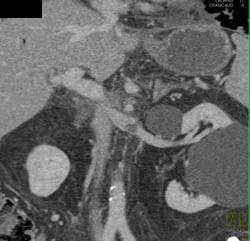 Clot in Renal Vein Following Pancreatitis - CTisus CT Scan