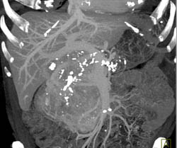 Islet Cell Tumor - CTisus CT Scan