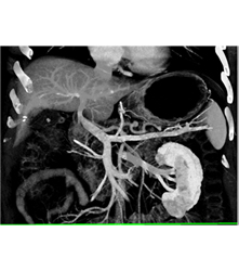 Example of User Bolus Triggering for Evaluation of the Pancreas With Dual Source CT - CTisus CT Scan