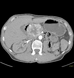 Islet Cell Tumor - CTisus CT Scan