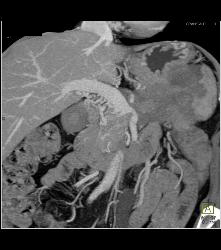 Islet Cell Tumor Tail of Pancreas - CTisus CT Scan