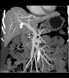 Intraductal Papillary Mucinous Neoplasm (IPMN) With Dysplastic Changes - CTisus CT Scan