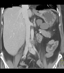 Lymphangioma - CTisus CT Scan