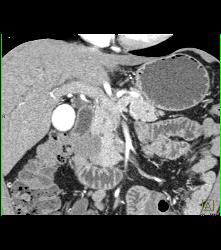 Ampullary Carcinoma S/p Endoscopic Retrograde Cholangiopancreatography (ERCP) - CTisus CT Scan