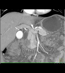 Ampullary Carcinoma S/p Endoscopic Retrograde Cholangiopancreatography (ERCP) - CTisus CT Scan