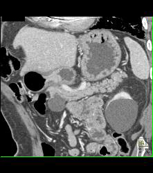 Intraductal Papillary Mucinous Neoplasm (IPMN) - See Full Sequence - CTisus CT Scan