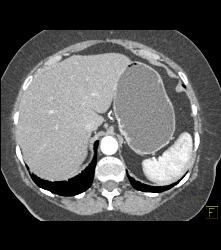 Atrophic Pancreas Without Mass - CTisus CT Scan