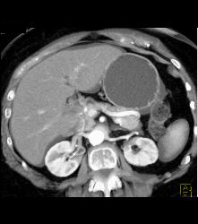 Atrophic Pancreas Without Mass - CTisus CT Scan