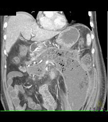 Pancreatic Necrosis With Abscess Involving the Psoas Muscle - CTisus CT Scan
