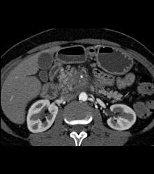 Pancreatic Cancer Encases the PV/SMV Confluence - CTisus CT Scan