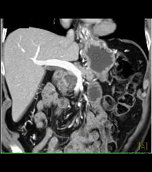 Intraductal Papillary Mucinous Neoplasm (IPMN) - CTisus CT Scan