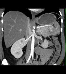 Islet Cell Tumor of the Tail of the Pancreas - CTisus CT Scan