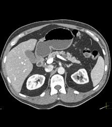 Intraductal Papillary Mucinous Neoplasm (IPMN) - CTisus CT Scan