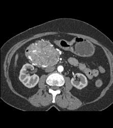 Serous Cystadenoma With Prominent Vessels Around the Head of the Pancreas - CTisus CT Scan