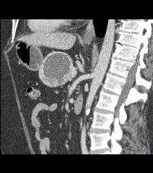 Cystic Islet Cell Tumor - CTisus CT Scan