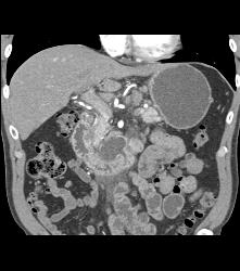 Pancreatic Cancer With Nodes and Duodenal Diverticulum - CTisus CT Scan