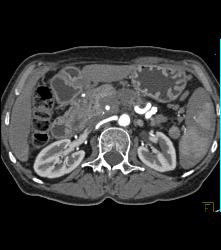 Pancreatic Cancer Encases the Superior Mesenteric Artery (SMA) and Celiac Artery and PV/SMV - CTisus CT Scan