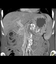 Pancreatic Cancer Encases the Superior Mesenteric Artery (SMA) and Celiac Artery and PV/SMV - CTisus CT Scan