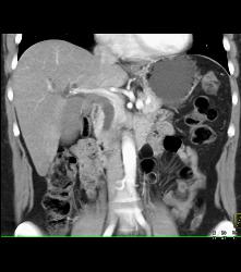Ampullary Carcinoma - CTisus CT Scan