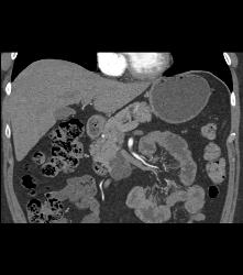 Intraductal Papillary Mucinous Neoplasm (IPMN) With Dysplastic Changes - CTisus CT Scan