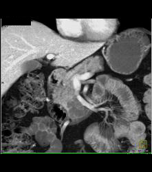 Intraductal Papillary Mucinous Neoplasm (IPMN) With Dysplastic Changes - CTisus CT Scan