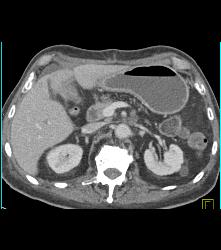 Recurrent Pancreatic Cancer S/p Whipple Procedure - CTisus CT Scan