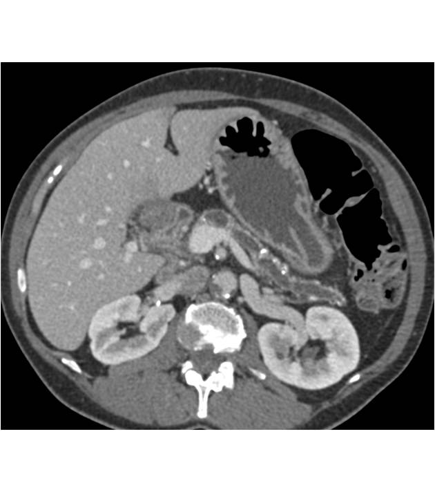 Dilated Pancreatic Duct with Atrophic Pancreatic Gland - CTisus CT Scan