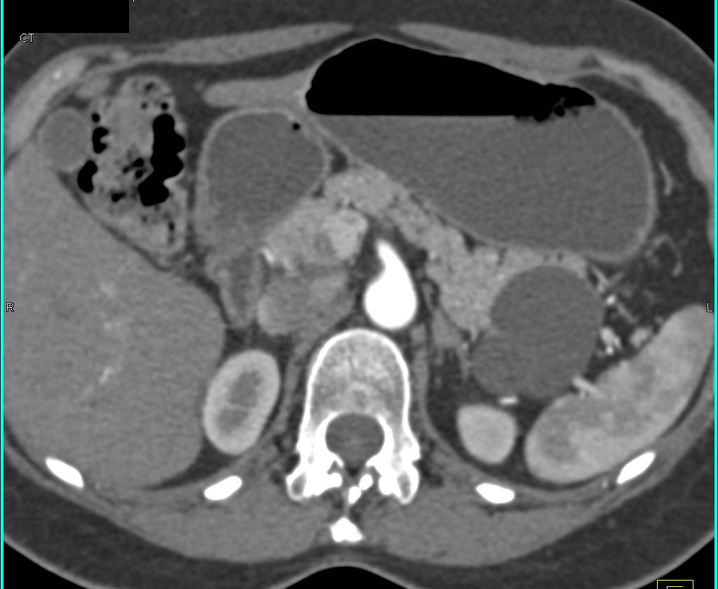 Mucinous Cystic Neoplasm in Tail of the Pancreas - CTisus CT Scan