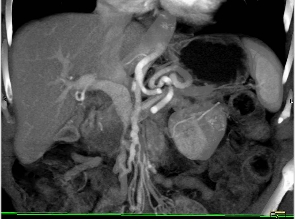 Pancreatic Cancer Encases the Superior Mesenteric Artery (SMA) and Superior Mesenteric Vein (SMV) - CTisus CT Scan