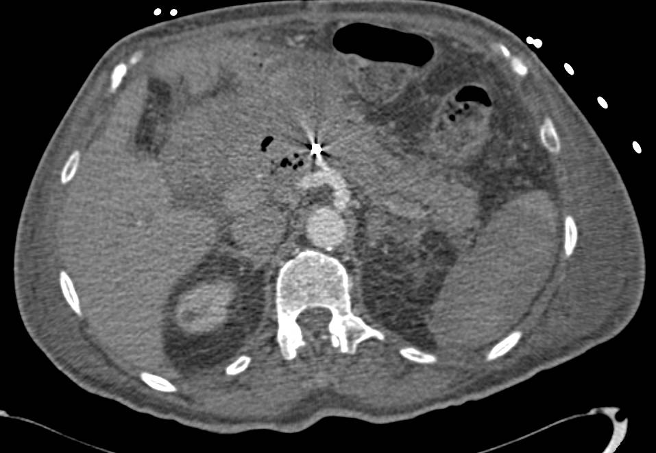 Pancreatitis with Pancreatic Necrosis and Splenic Infarction - CTisus CT Scan