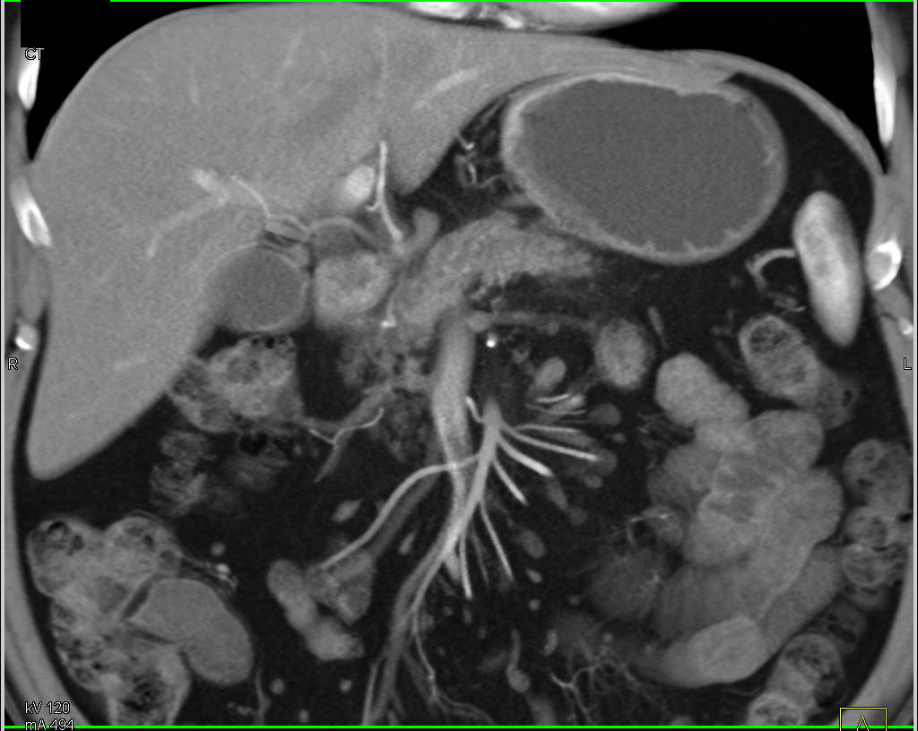 Pancreatic Cancer with Hepatic Artery and Portal Vein (PV) Involvement Best Seen on 3D Images - CTisus CT Scan