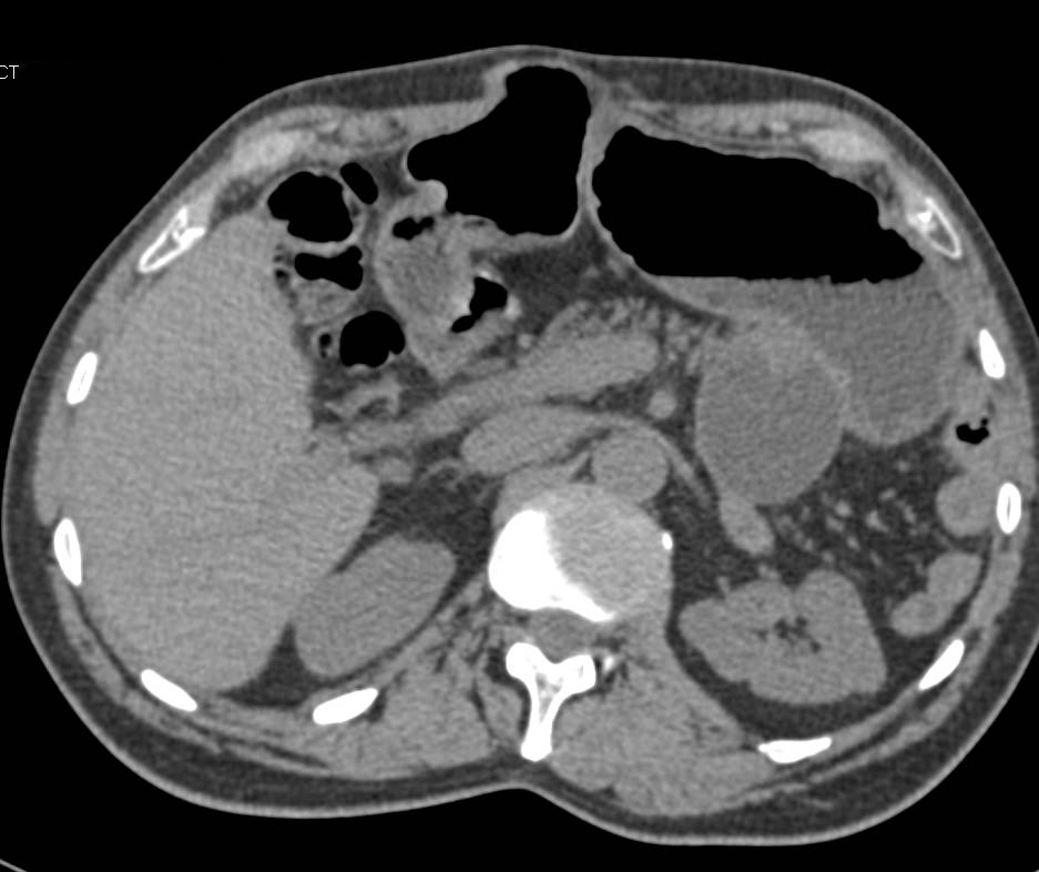 Intraductal Papillary Mucinous Neoplasm (IPMN) Tail of Pancreas - CTisus CT Scan