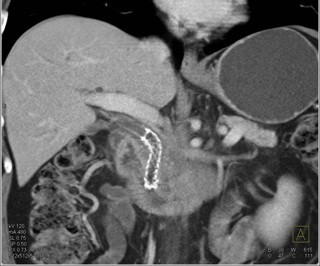 Stent in Common Bile Duct in Patient with Pancreatic Cancer - CTisus CT Scan