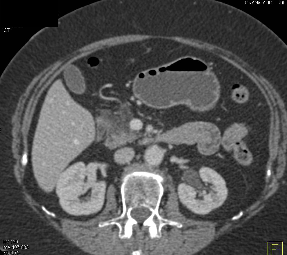 Acute Pancreatitis (mild) - CTisus CT Scan