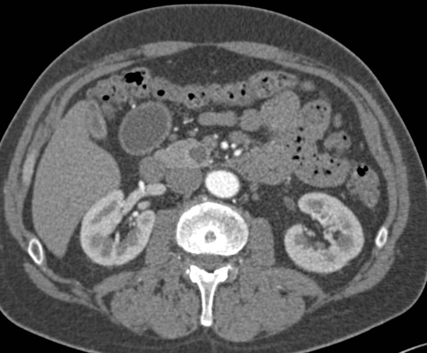 Cystic Islet Cell Tumor of the Pancreatic Head with Rim Enhancement - CTisus CT Scan