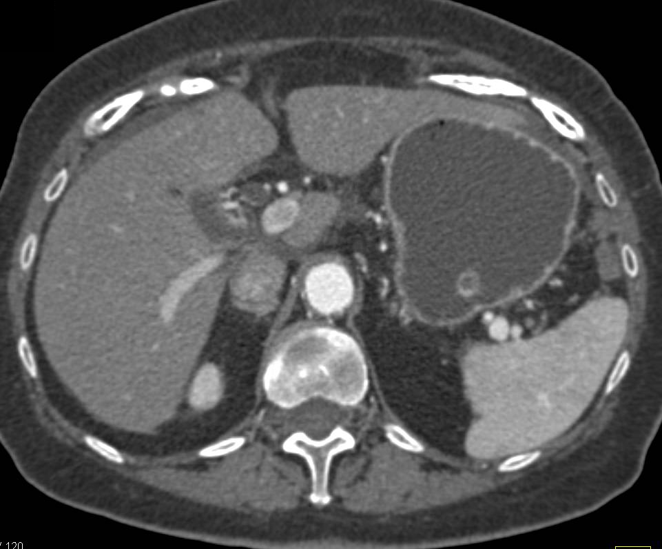 Carcinoma of the Tail of the Pancreas with Carcinomatosis to Stomach and Omentum - CTisus CT Scan
