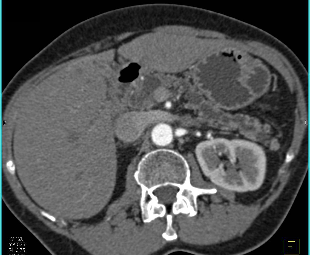 Multiple Intraductal Papillary Mucinous Neoplasms (IPMNs) with Dilated Pancreatic Duct and Carcinoma in the Head of the Pancreas - CTisus CT Scan