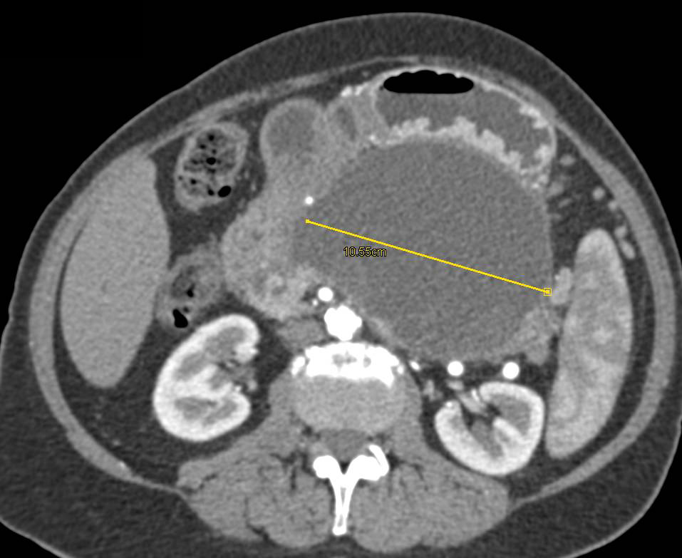 Pancreatic Pseudocyst Occludes the Splenic Vein with Extensive Collaterals Seen - CTisus CT Scan