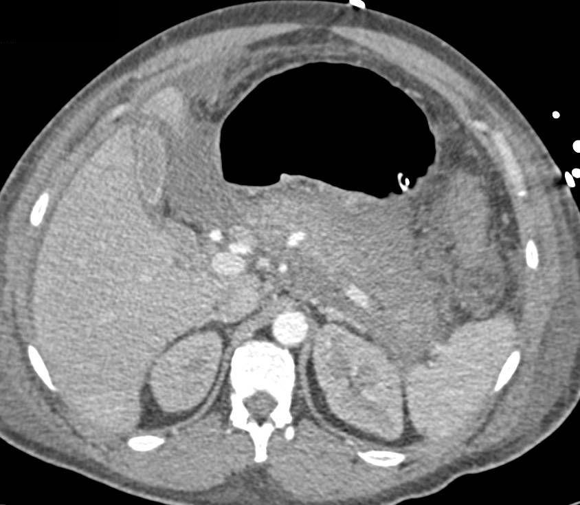 Acute Pancreatitis with Pancreatic Ascites - CTisus CT Scan
