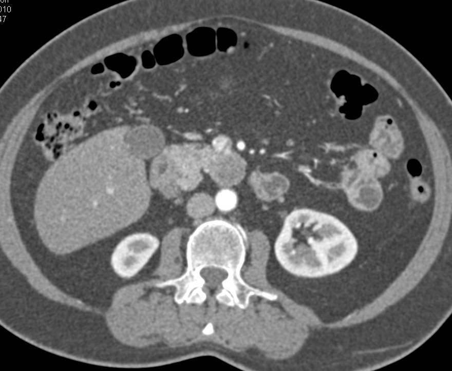 Cystic Islet Cell Tumor of the Pancreatic Head with Subtle Rim Enhancement - CTisus CT Scan