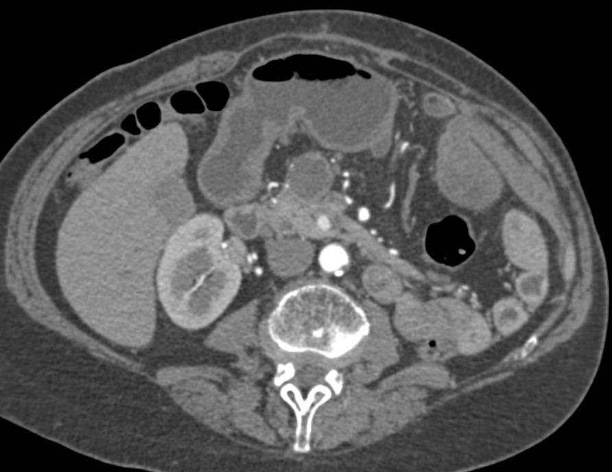 Cystic Islet Cell Tumor of the Pancreatic Head - CTisus CT Scan