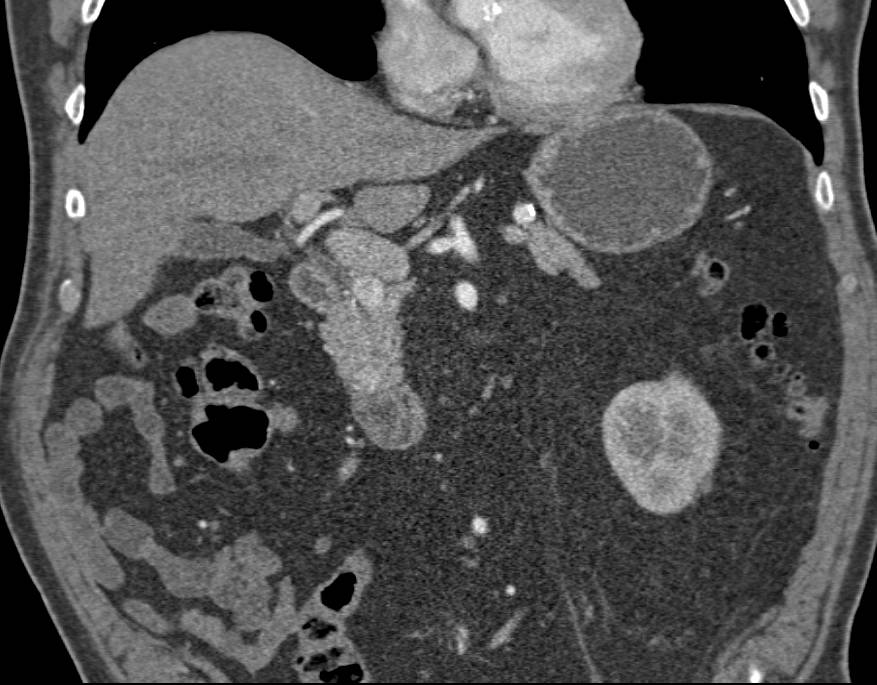Multiple Vascular Lesions in the Pancreas due to Metastatic Renal Cell Carcinoma - CTisus CT Scan
