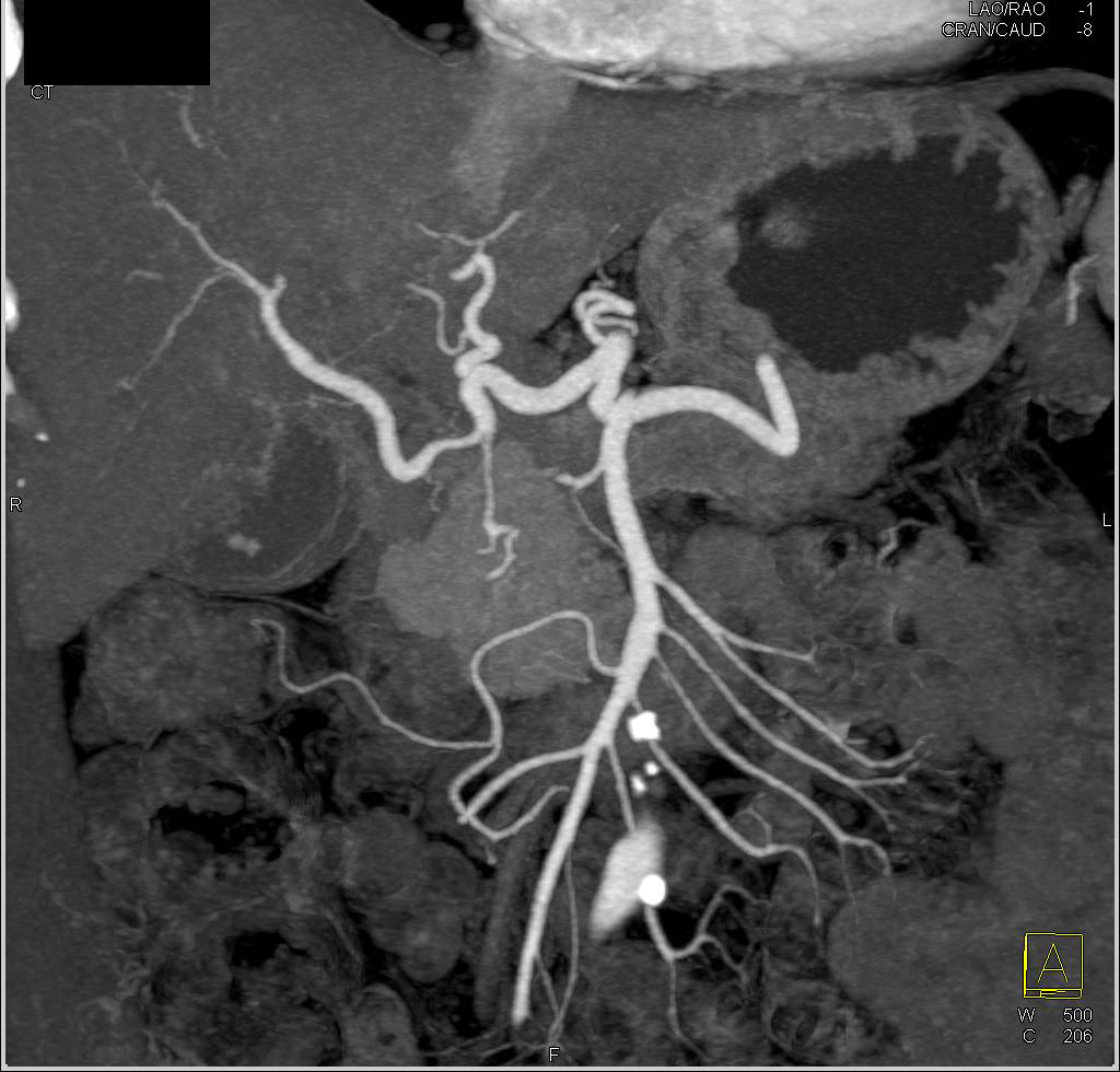Pancreatic Cancer Encases the PV/SMV Confluence - CTisus CT Scan