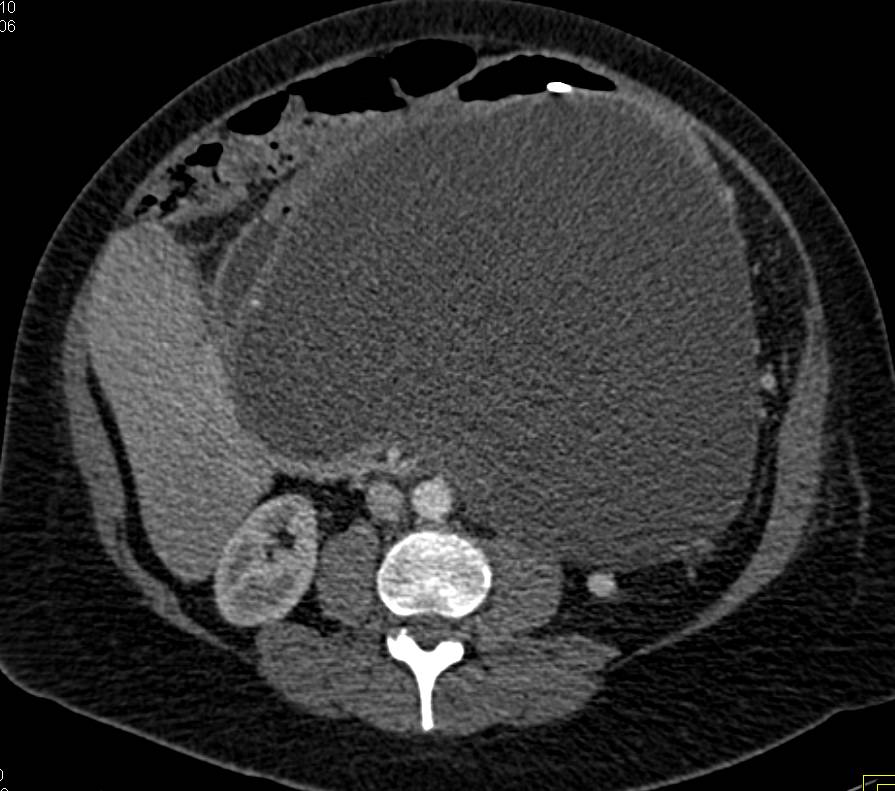 Large Pseudocyst in Lesser Sac due to Pancreatitis - CTisus CT Scan